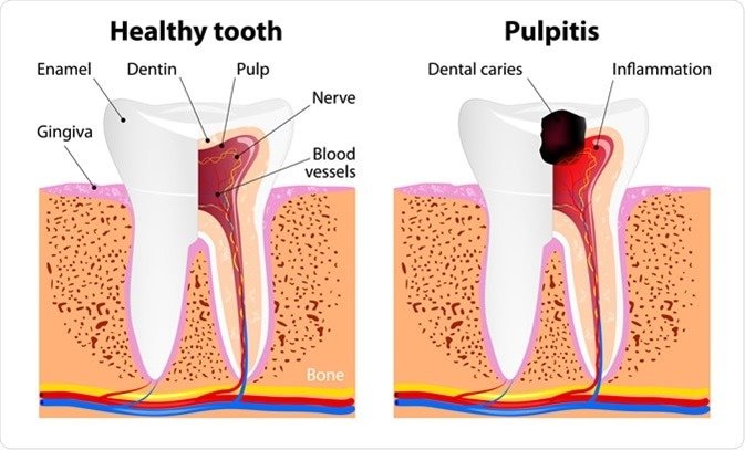 Лечение пульпита зуба цена thumbnail